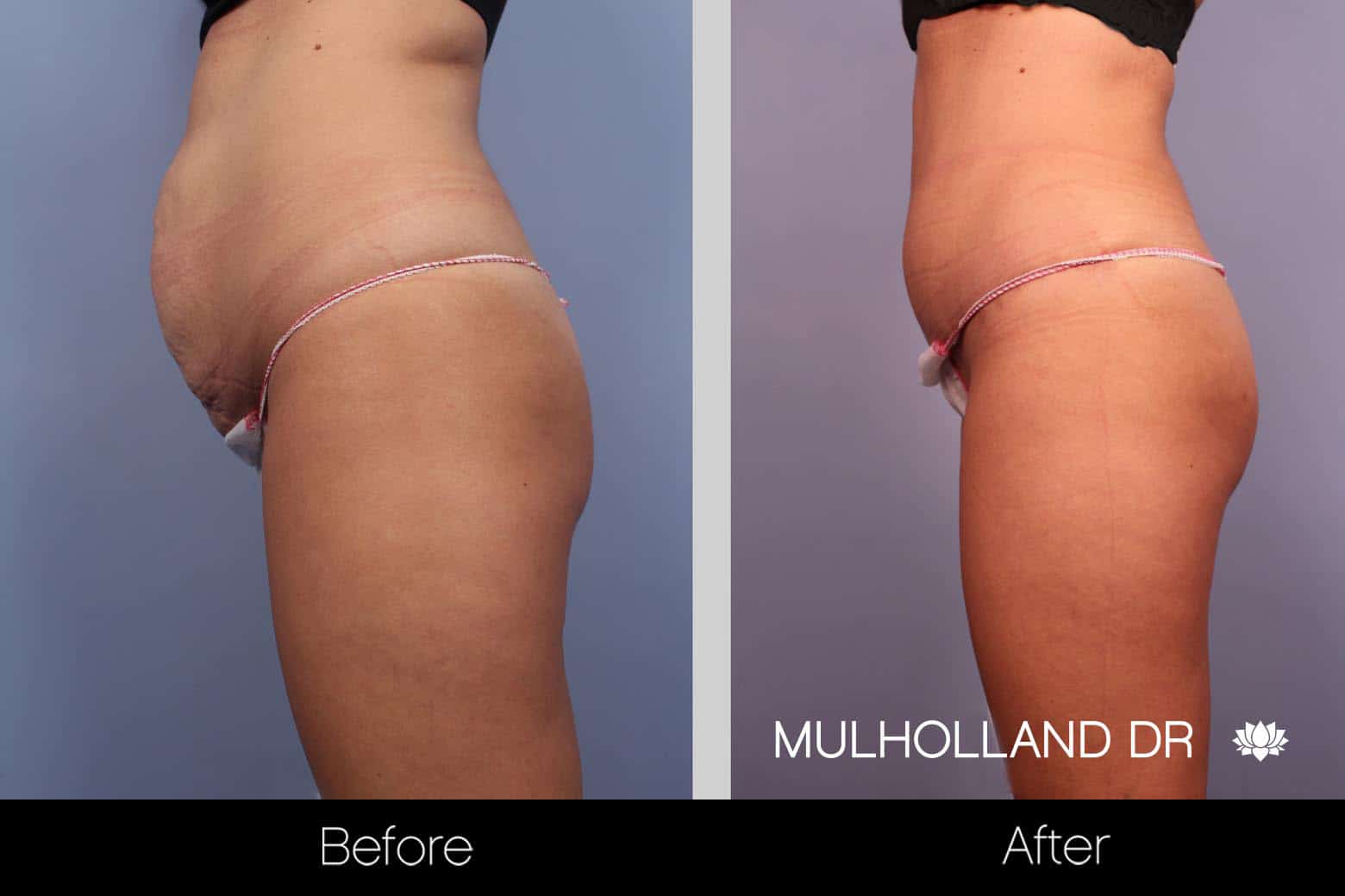 Tummy Tuck - Before and After Gallery – Photo 15