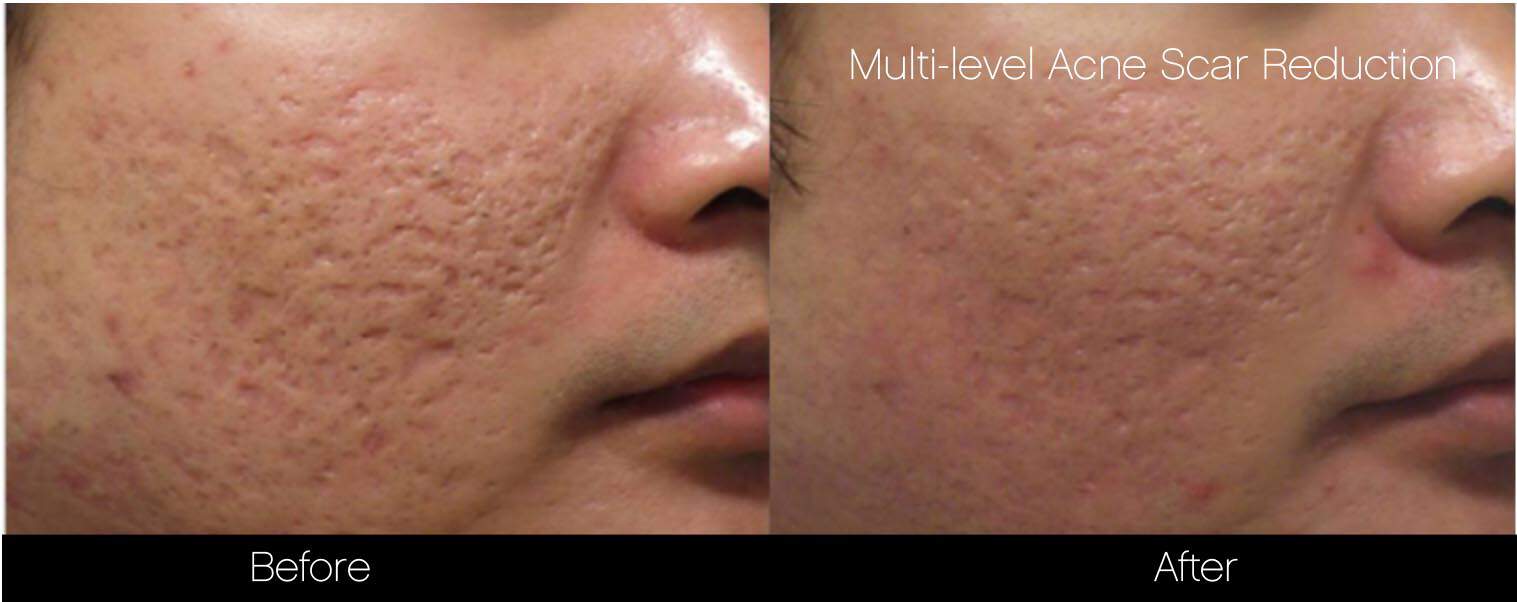 Acne Scar Treatments - Before and After Gallery – Photo 15