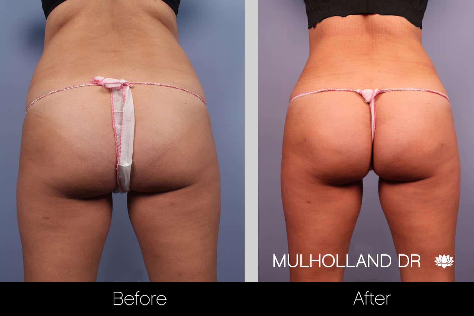 Tummy Tuck - Before and After Gallery – Photo 16