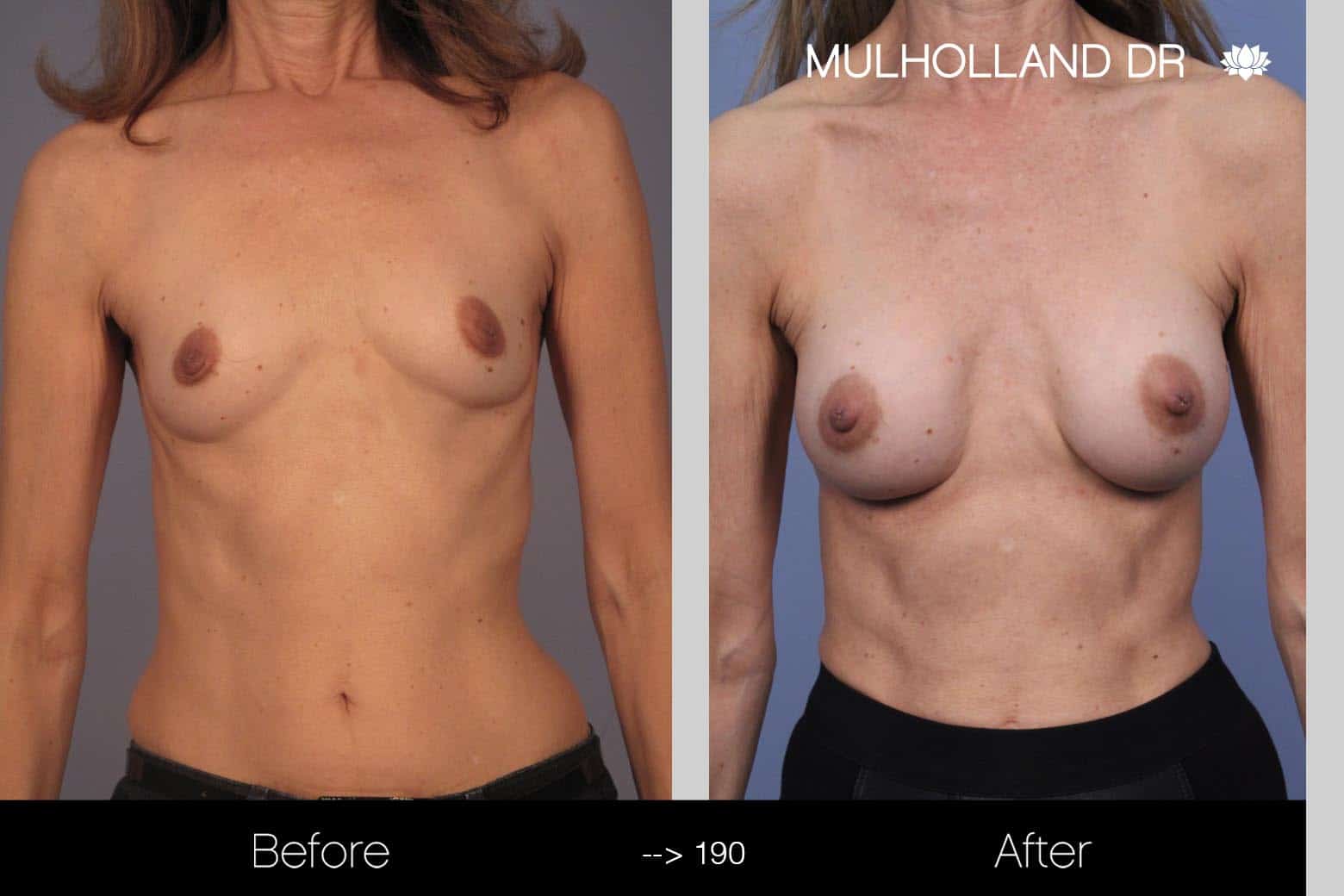 Fat Grafting Breast Augmentation - Before and After Gallery – Photo 16