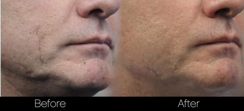 Dramatic before and after comparison showing significant improvement in the appearance after scarring laser treatment at SpaMedica in Toronto.
