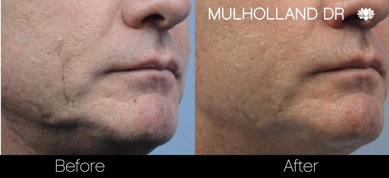 Acne Scar Treatments - Before and After Gallery – Photo 16