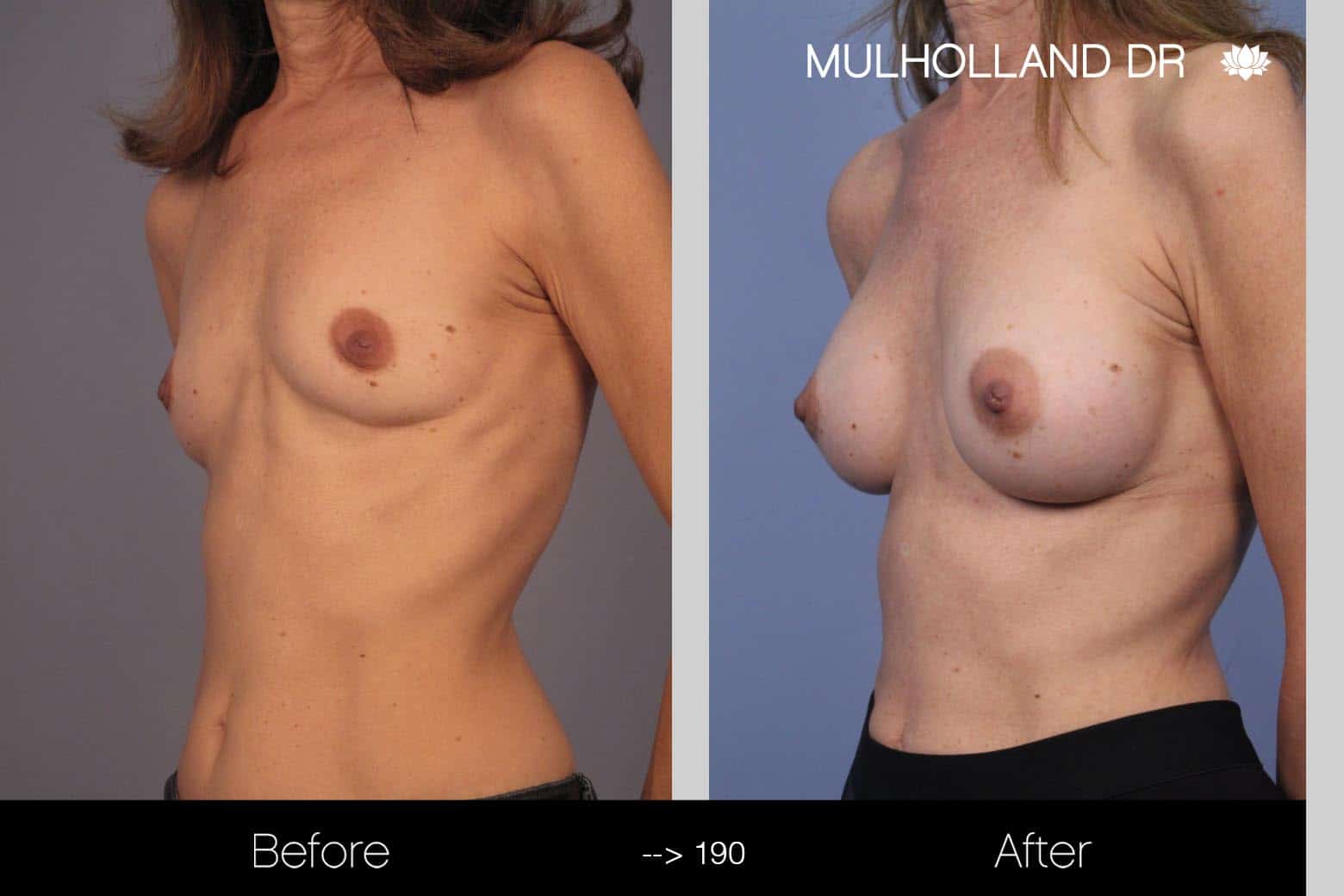 Fat Grafting Breast Augmentation - Before and After Gallery – Photo 17