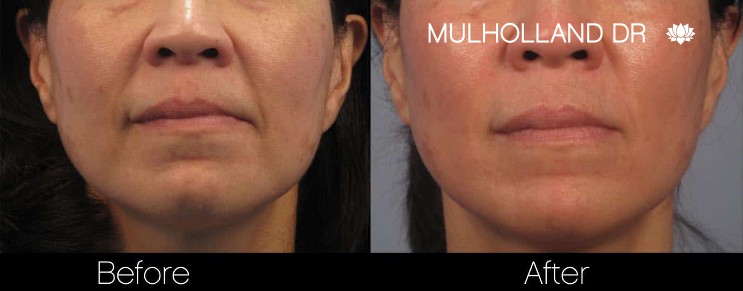Acne Scar Treatments - Before and After Gallery – Photo 17