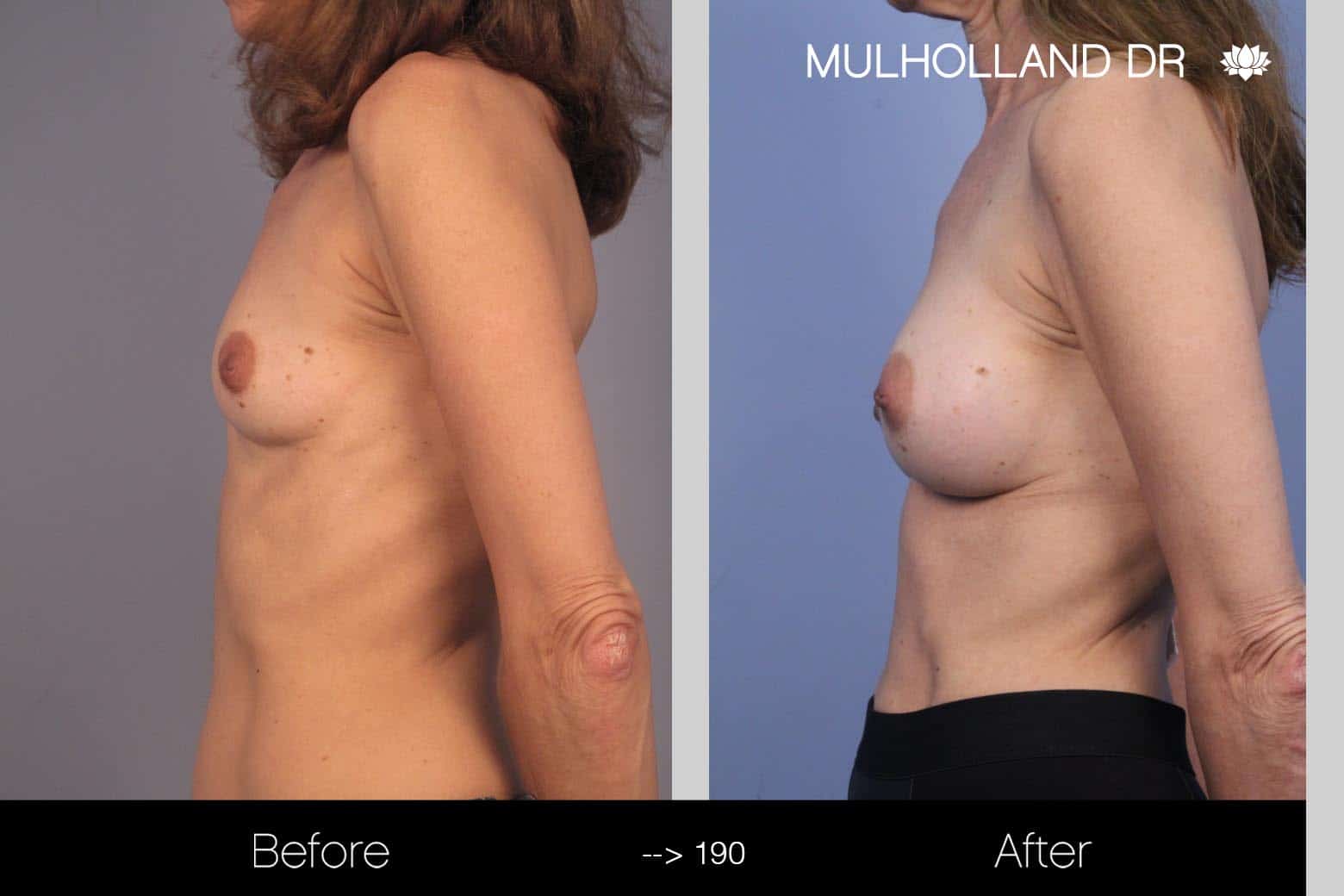 Fat Grafting Breast Augmentation - Before and After Gallery – Photo 18