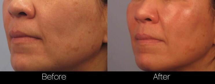Acne Scar Treatments - Before and After Gallery – Photo 18