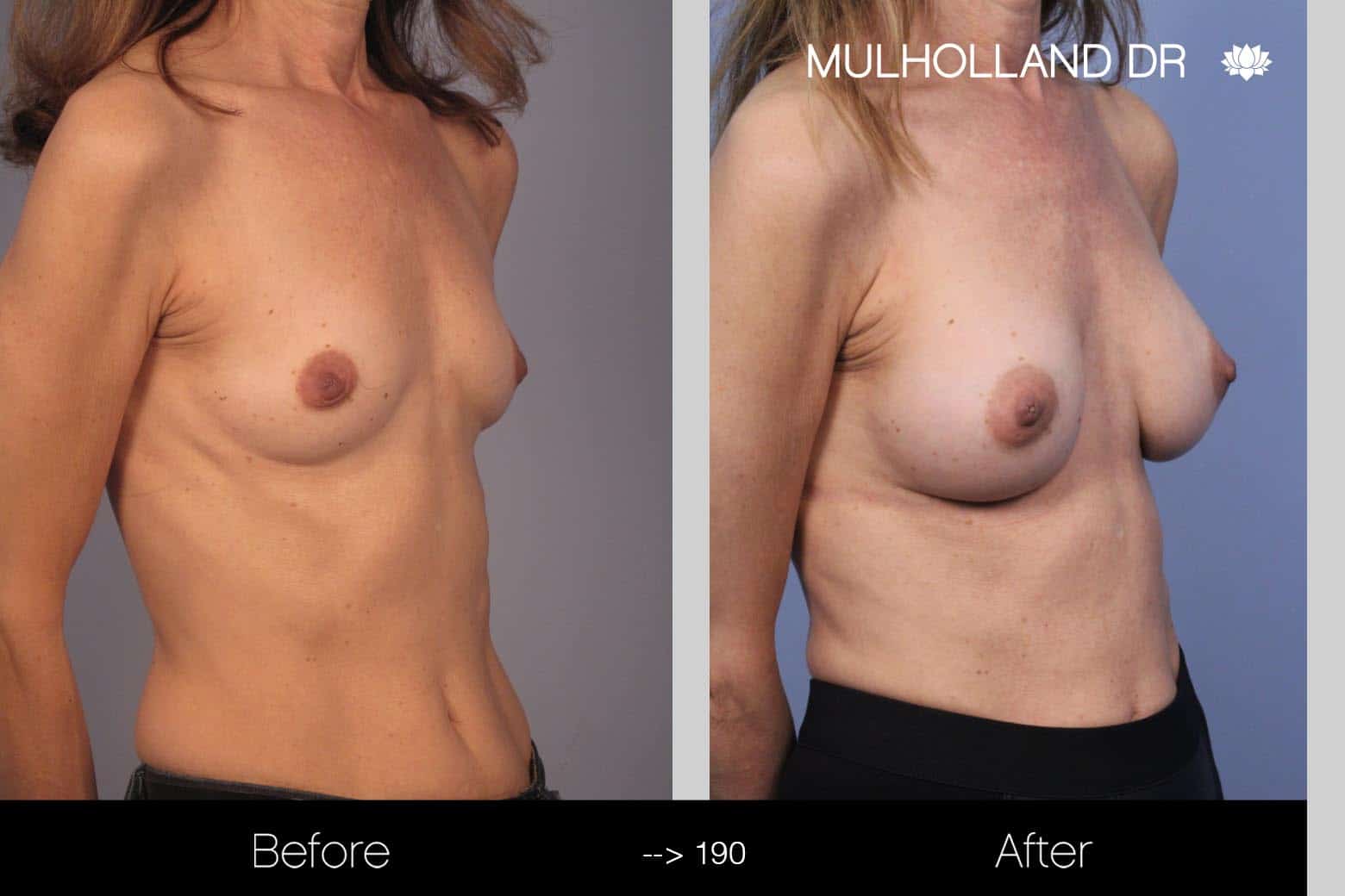 Fat Grafting Breast Augmentation - Before and After Gallery – Photo 19