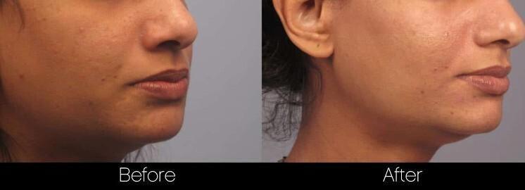 Acne Scar Treatments - Before and After Gallery – Photo 19