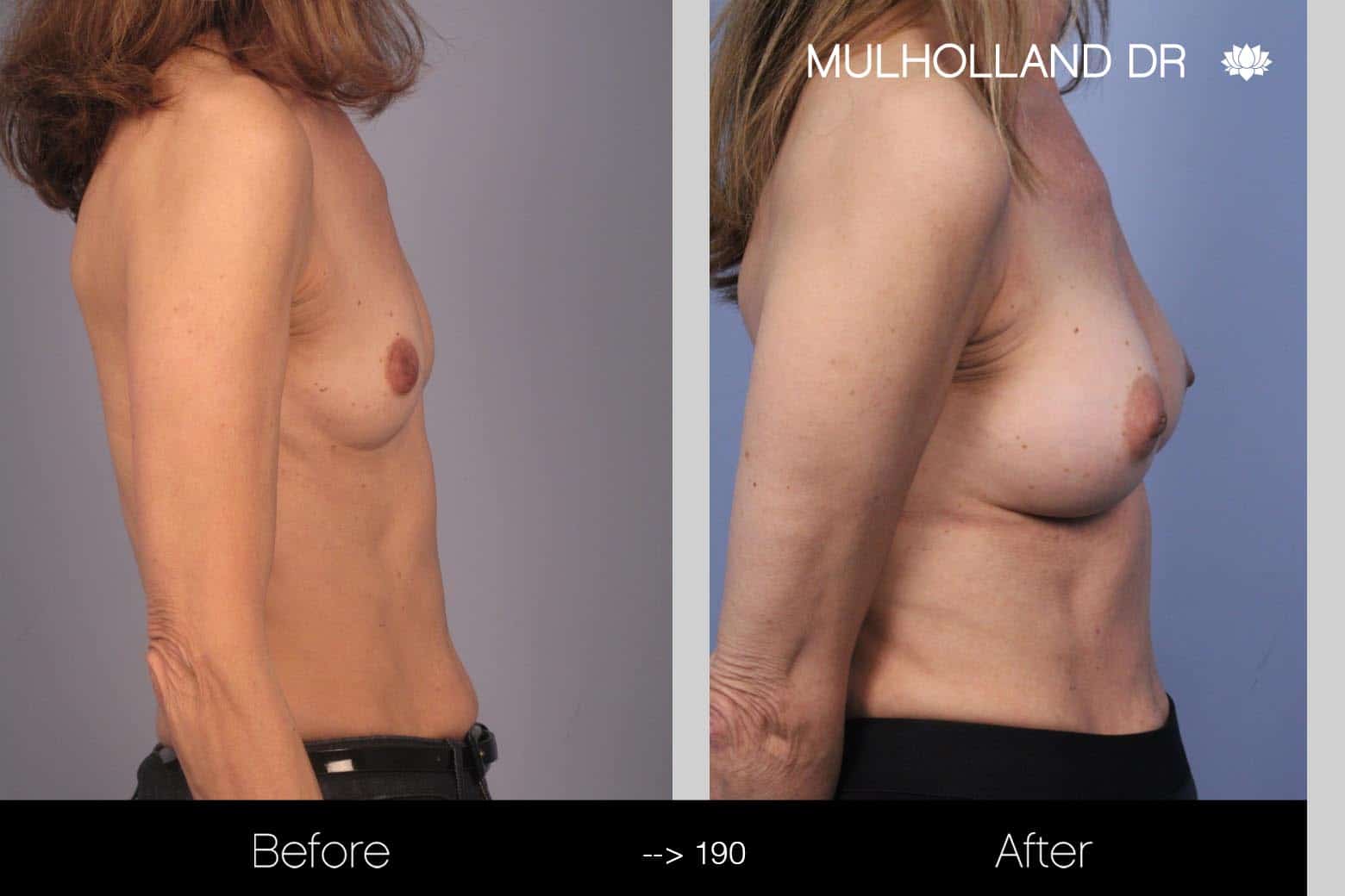 Fat Grafting Breast Augmentation - Before and After Gallery – Photo 20