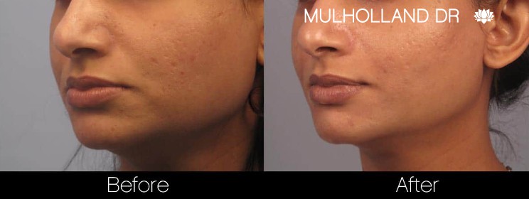 Acne Scar Treatments - Before and After Gallery – Photo 20