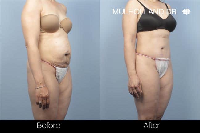 Tummy Tuck - Before and After Gallery – Photo 26