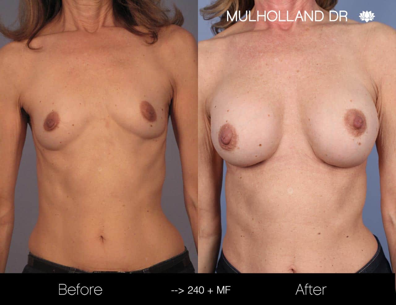 Fat Grafting Breast Augmentation - Before and After Gallery – Photo 21
