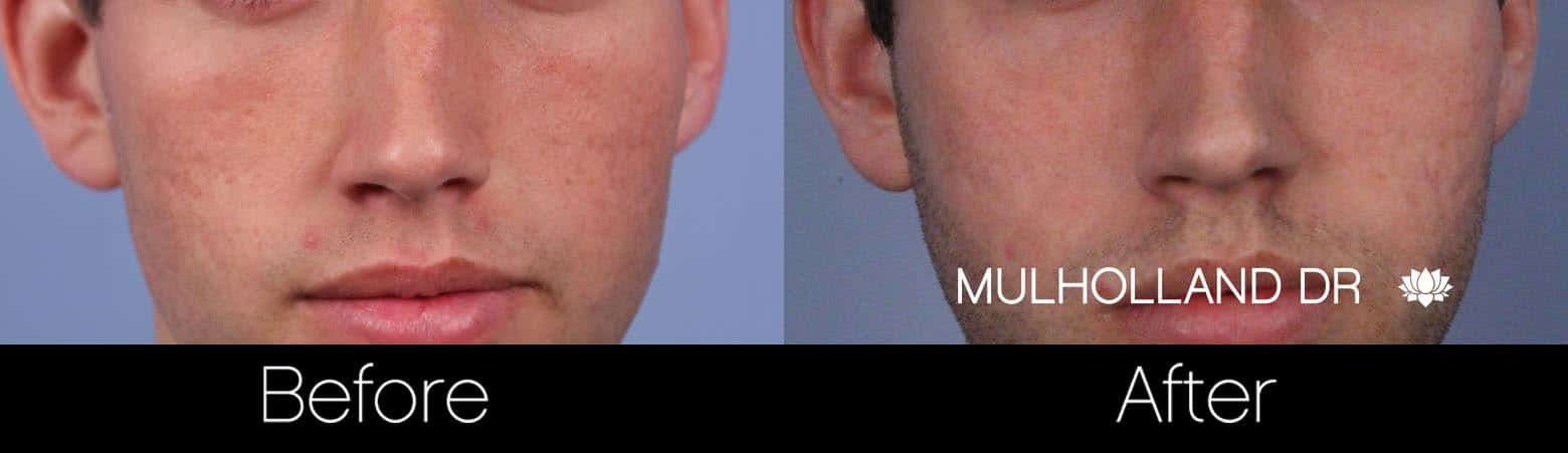 Acne Scar Treatments - Before and After Gallery – Photo 21