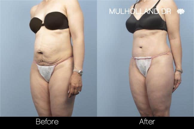 Tummy Tuck - Before and After Gallery – Photo 27