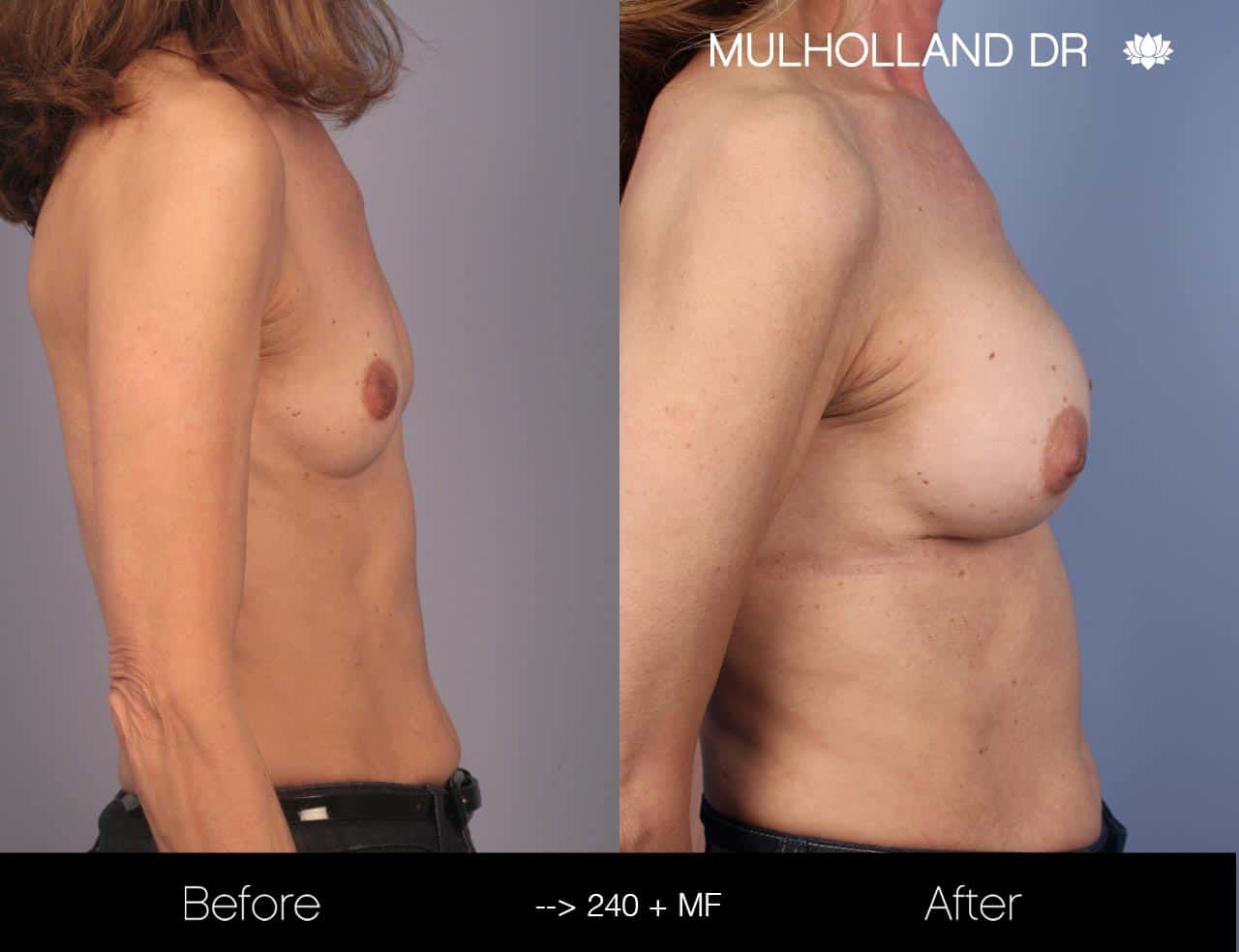 Fat Grafting Breast Augmentation - Before and After Gallery – Photo 22