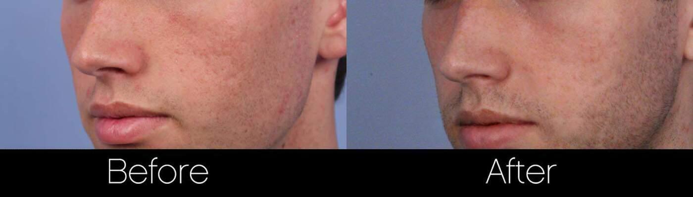 Acne Scar Treatments - Before and After Gallery – Photo 22