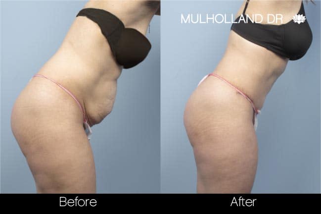 Tummy Tuck - Before and After Gallery – Photo 28