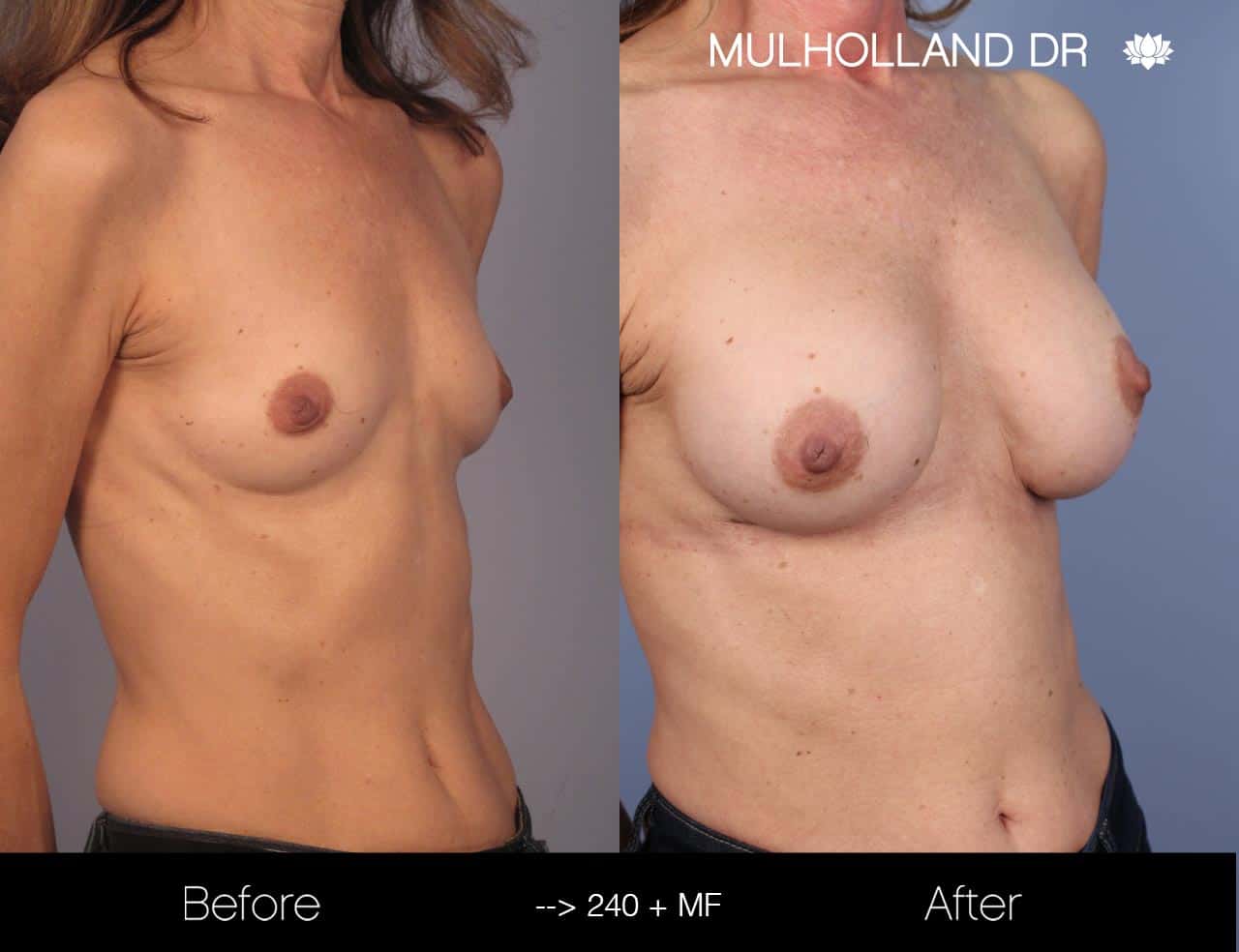 Fat Grafting Breast Augmentation - Before and After Gallery – Photo 23