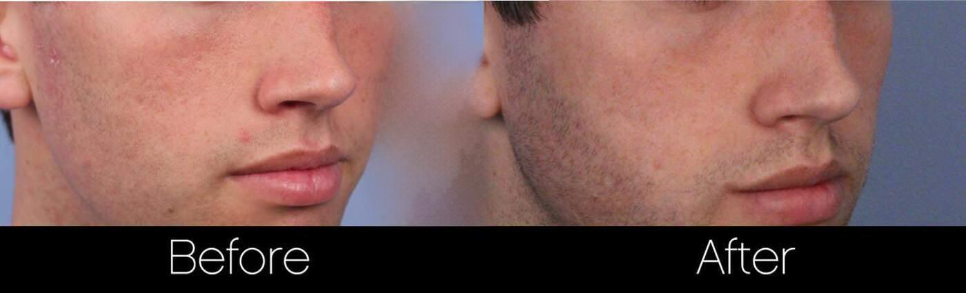 Acne Scar Treatments - Before and After Gallery – Photo 23