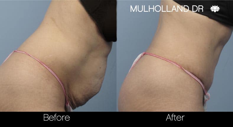 Tummy Tuck - Before and After Gallery – Photo 29