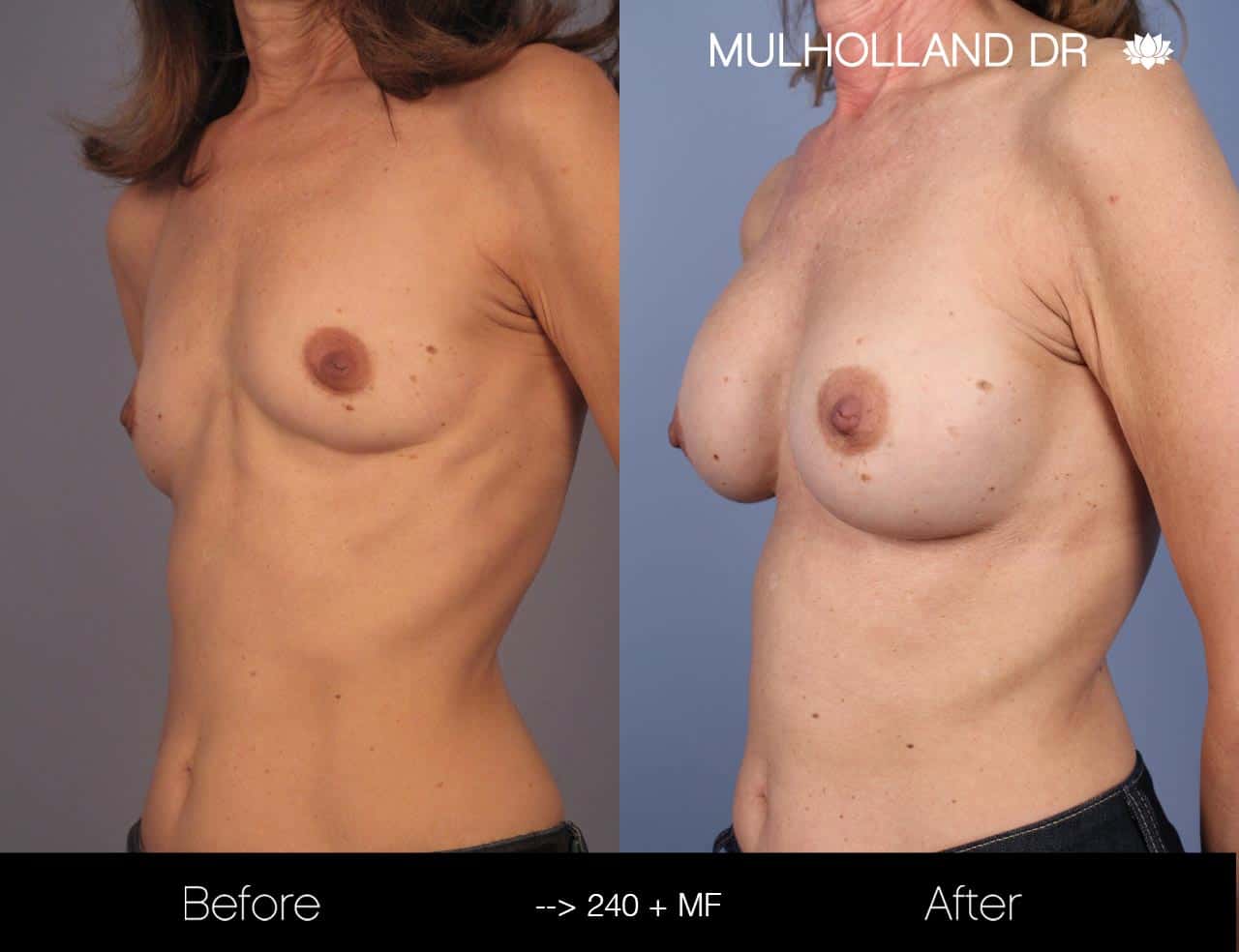 Fat Grafting Breast Augmentation - Before and After Gallery – Photo 24