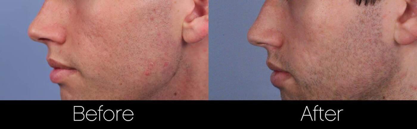 Acne Scar Treatments - Before and After Gallery – Photo 24