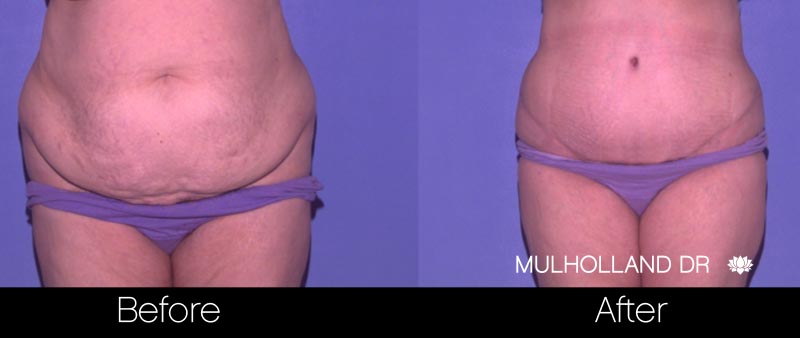 Tummy Tuck - Before and After Gallery – Photo 30