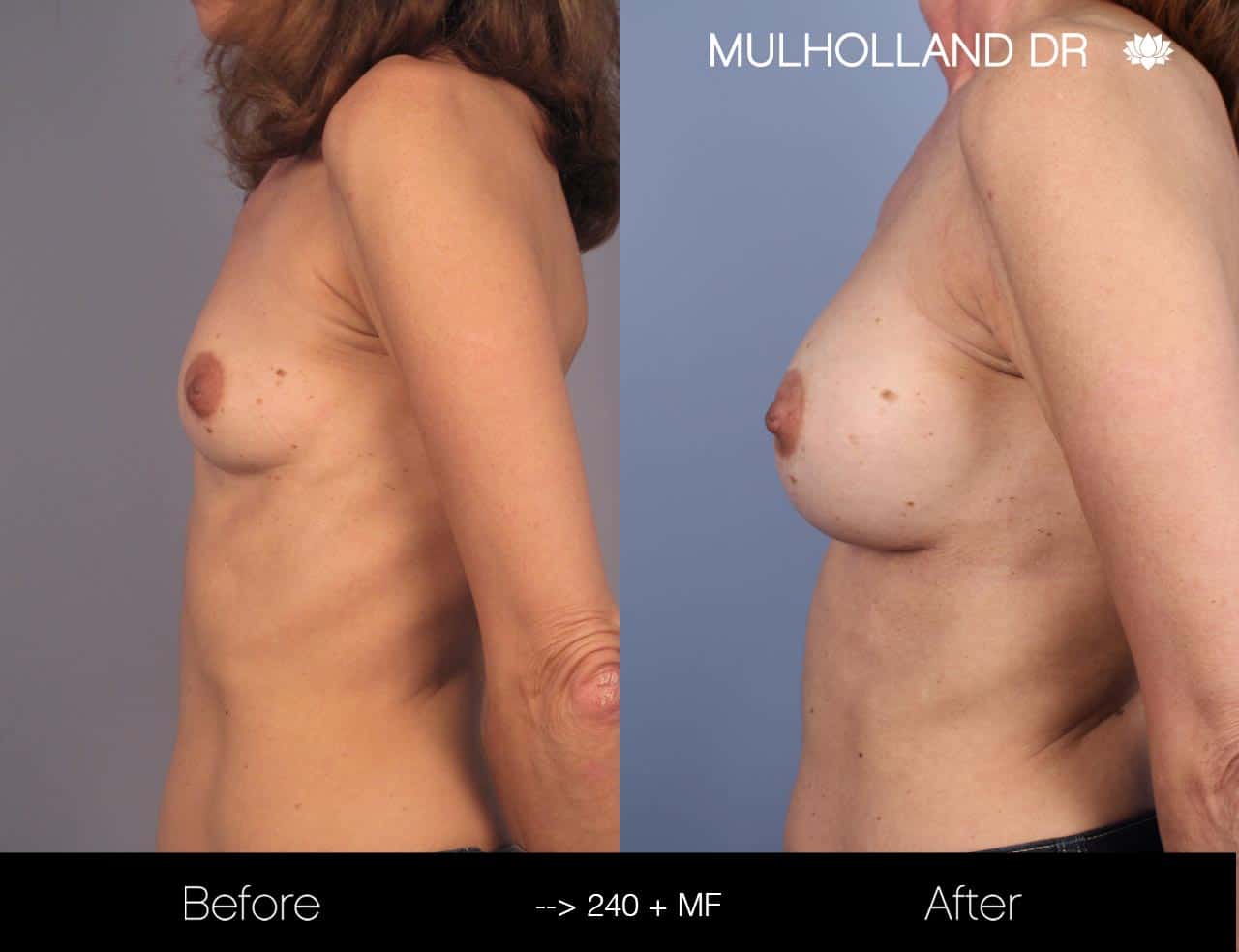 Fat Grafting Breast Augmentation - Before and After Gallery – Photo 25