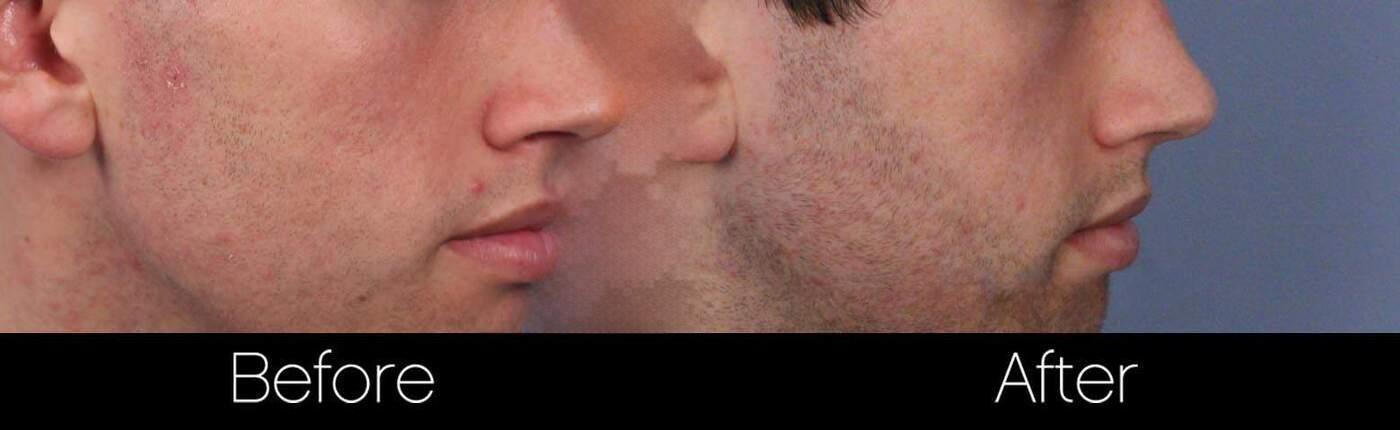 Acne Scar Treatments - Before and After Gallery – Photo 25