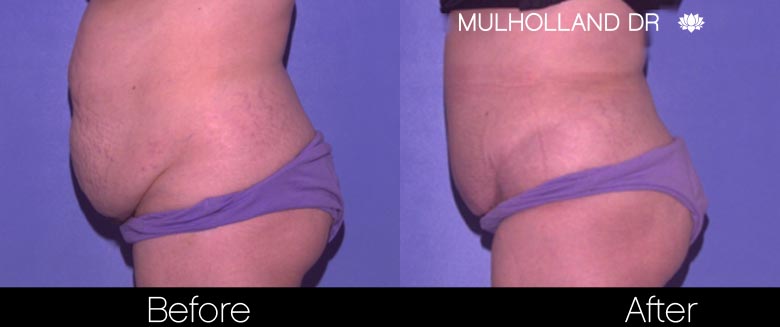 Mini Tummy Tuck - Before and After Gallery – Photo 26