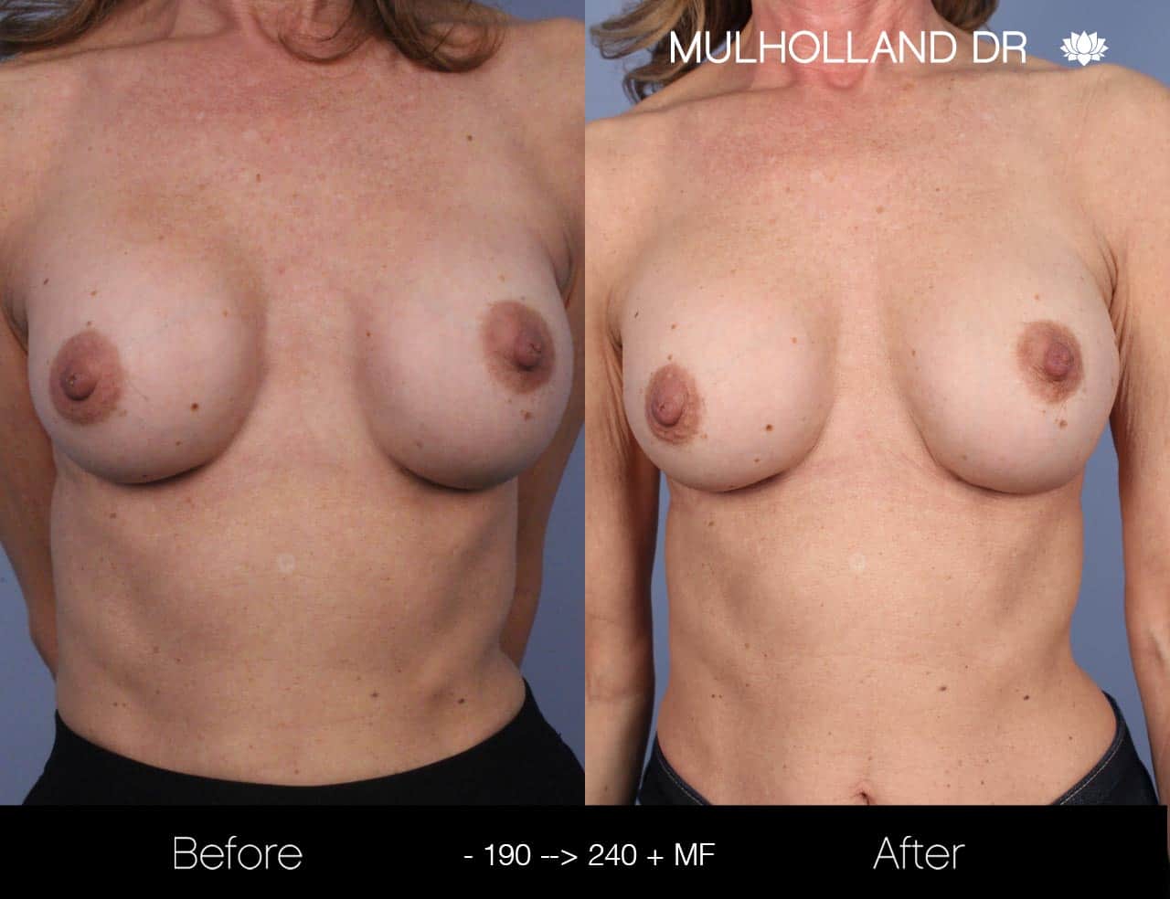 Fat Grafting Breast Augmentation - Before and After Gallery – Photo 26