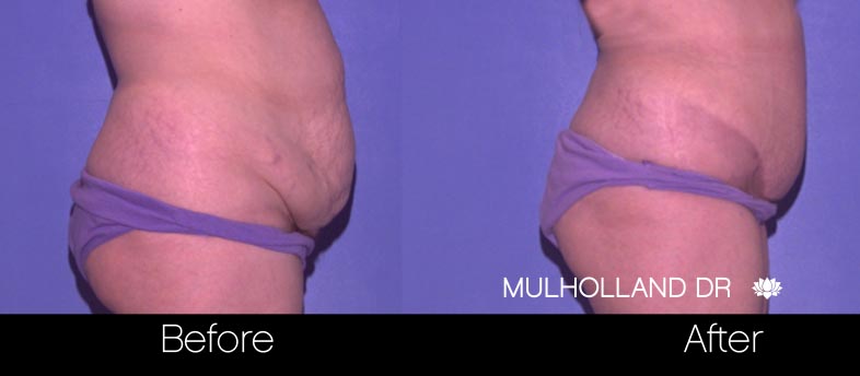 Mini Tummy Tuck - Before and After Gallery – Photo 27