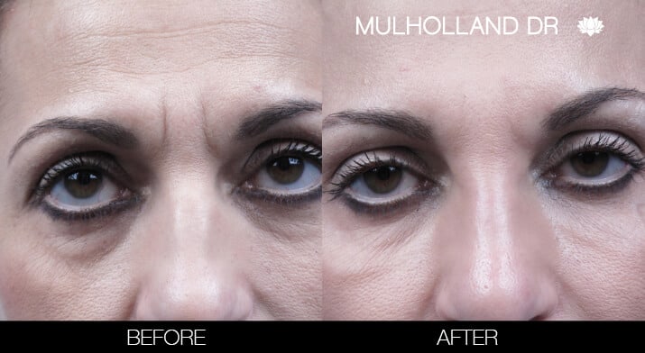 Fractional Erbium Laser - Before and After Gallery – Photo 20