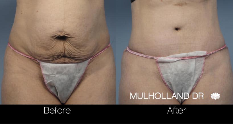 Tummy Tuck - Before and After Gallery – Photo 17