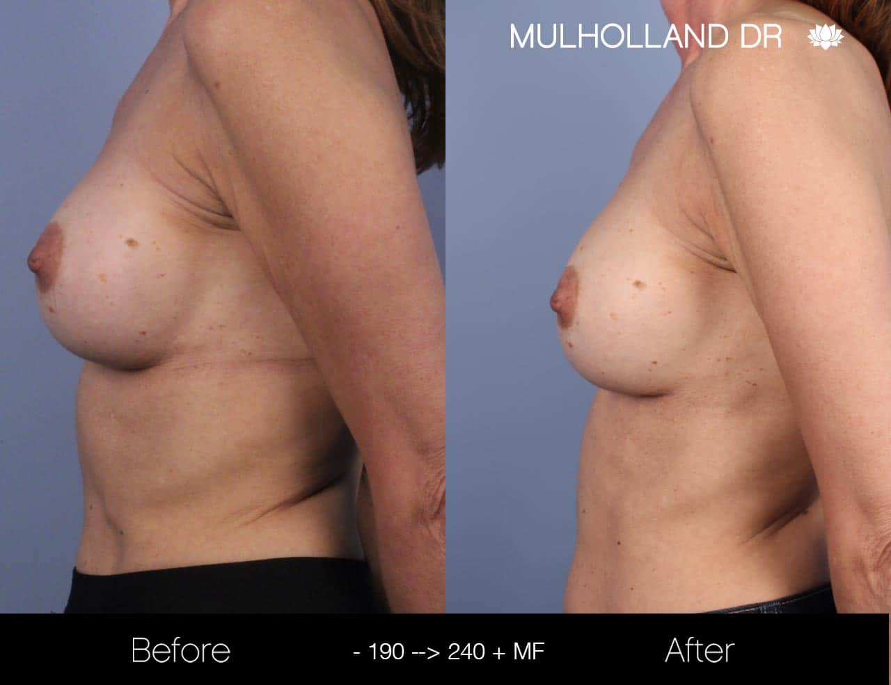 Fat Grafting Breast Augmentation - Before and After Gallery – Photo 28