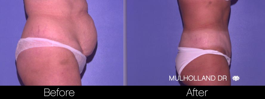 Mini Tummy Tuck - Before and After Gallery – Photo 29