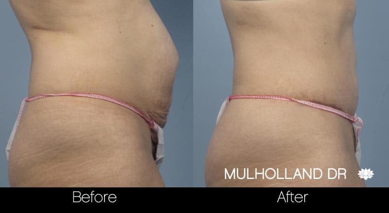 Tummy Tuck - Before and After Gallery – Photo 18