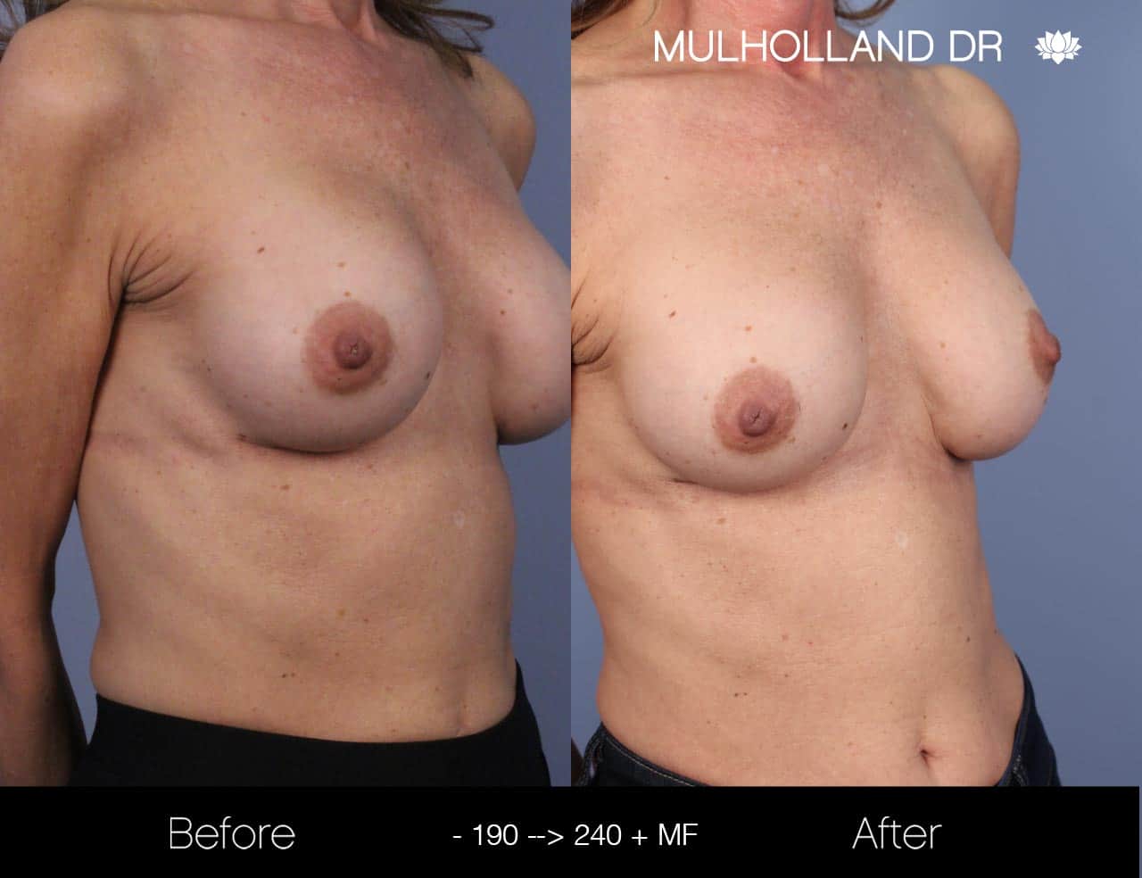 Fat Grafting Breast Augmentation - Before and After Gallery – Photo 29