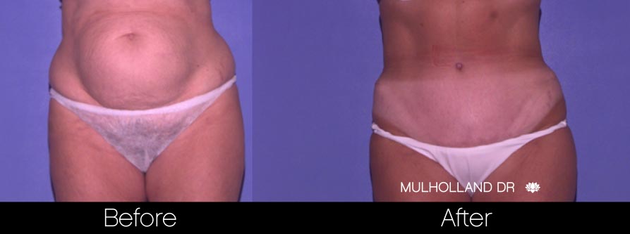 Mini Tummy Tuck - Before and After Gallery – Photo 30