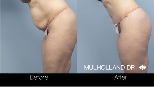 Tummy Tuck - Before and After Gallery – Photo 19