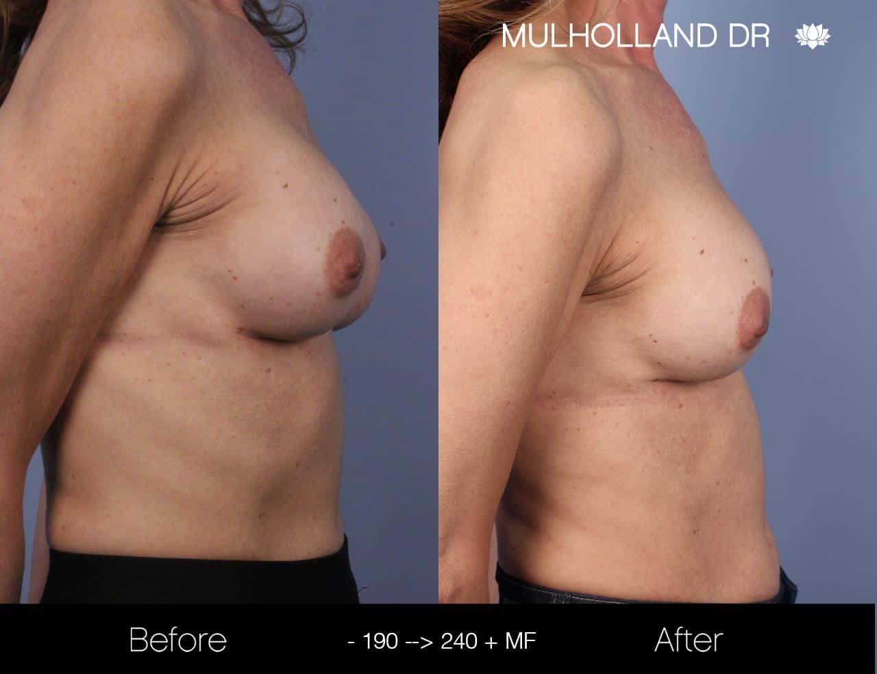 Fat Grafting Breast Augmentation - Before and After Gallery – Photo 30