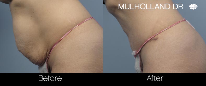 Tummy Tuck - Before and After Gallery – Photo 20