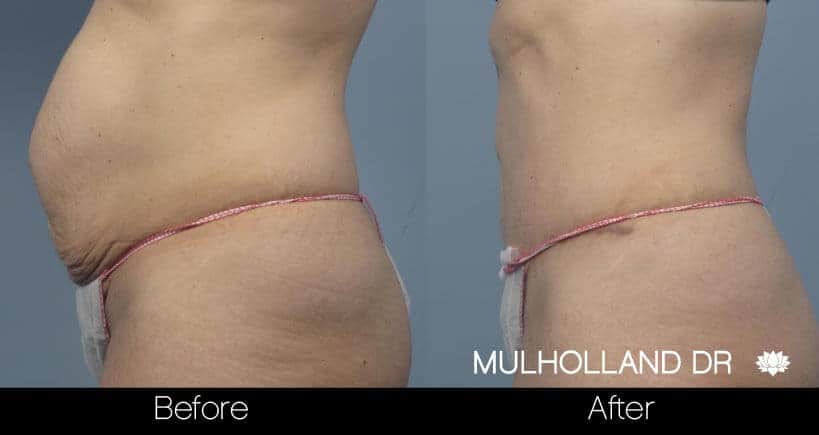 Tummy Tuck - Before and After Gallery – Photo 21