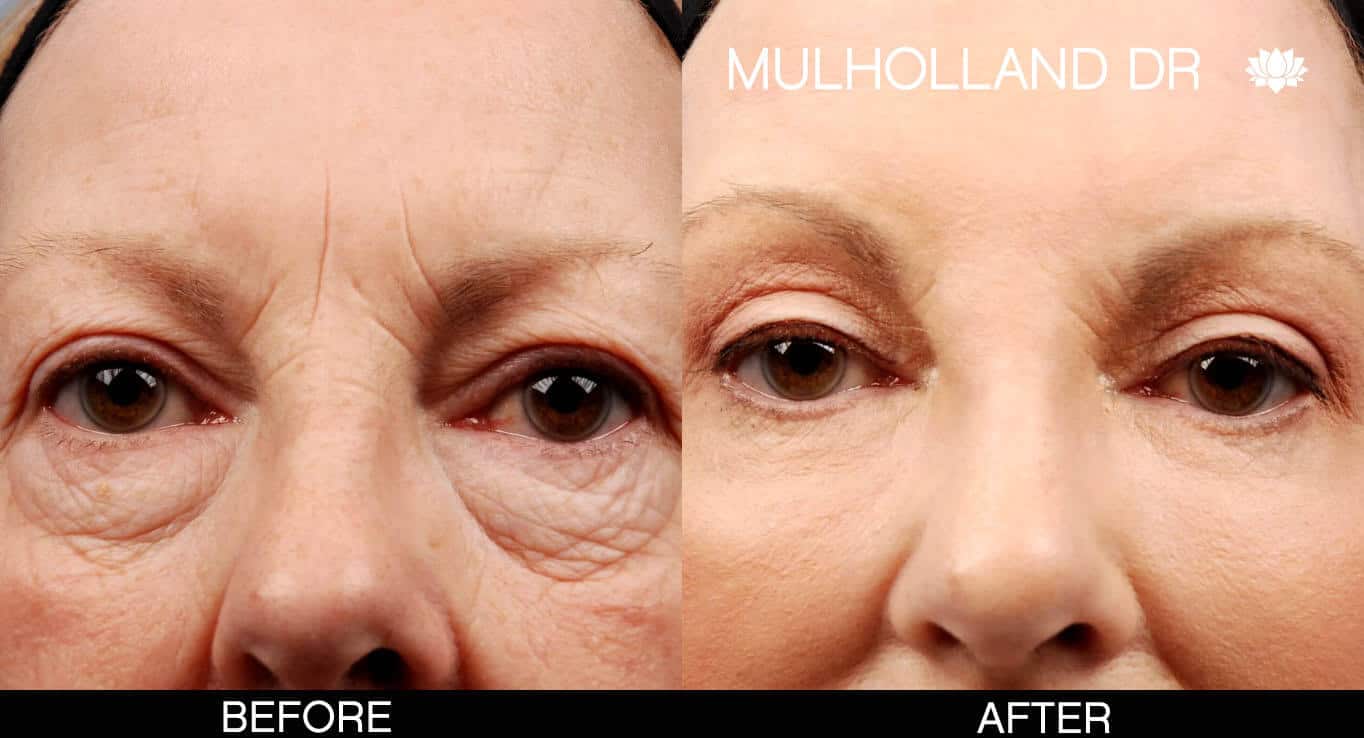 Fractional Erbium Laser - Before and After Gallery – Photo 22