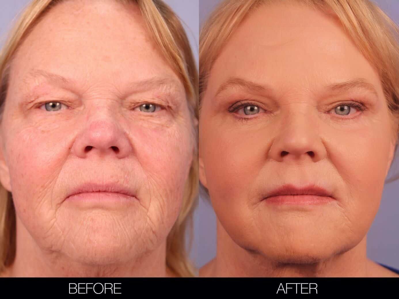 Fractional Erbium Laser - Before and After Gallery – Photo 30