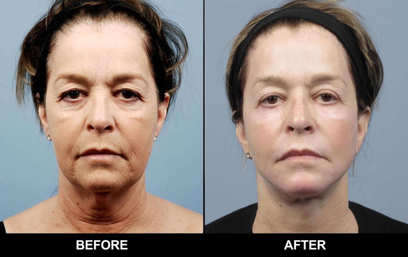 Fractional Erbium Laser - Before and After Gallery – Photo 33