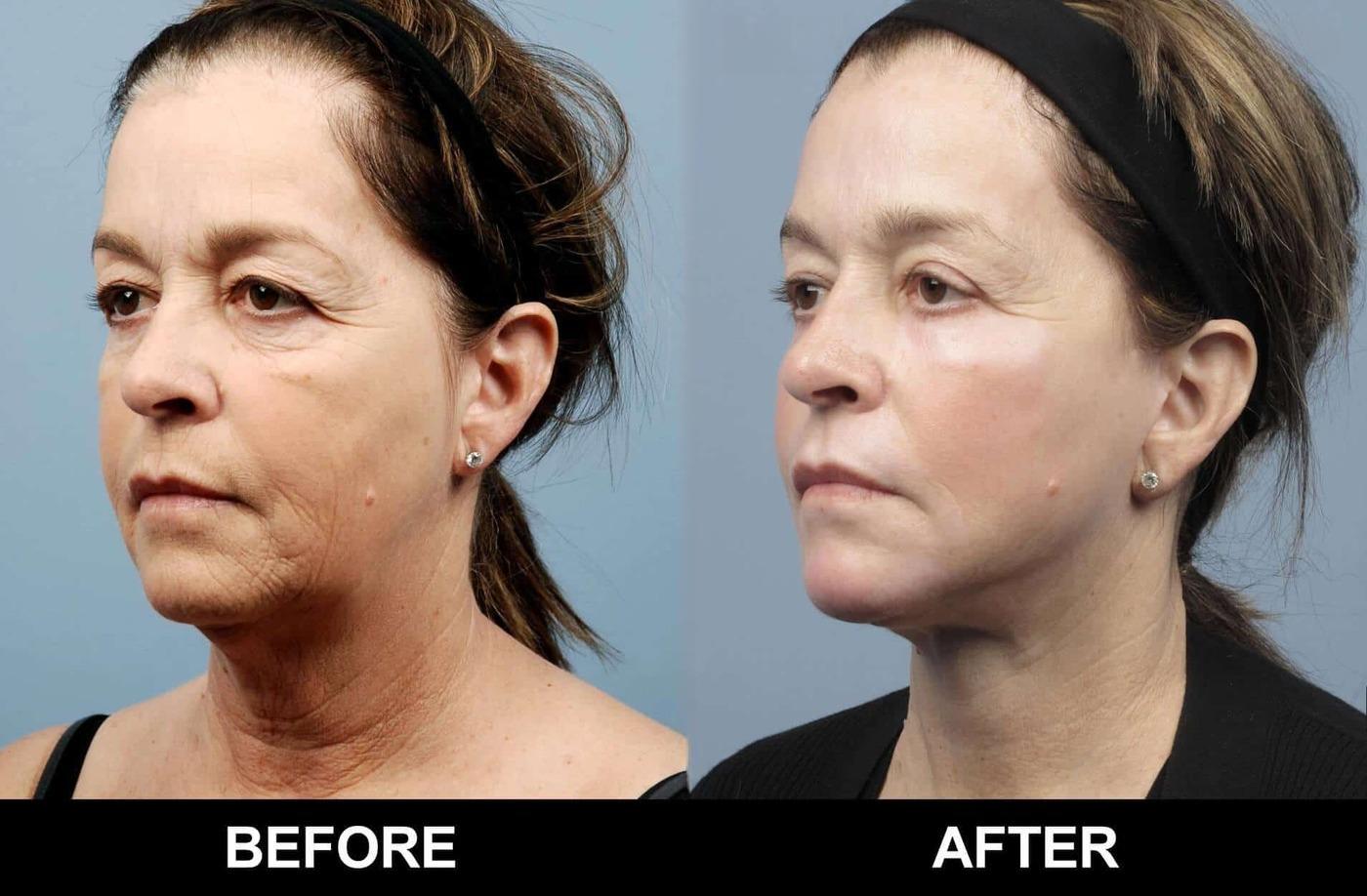 Fractional Erbium Laser - Before and After Gallery – Photo 42