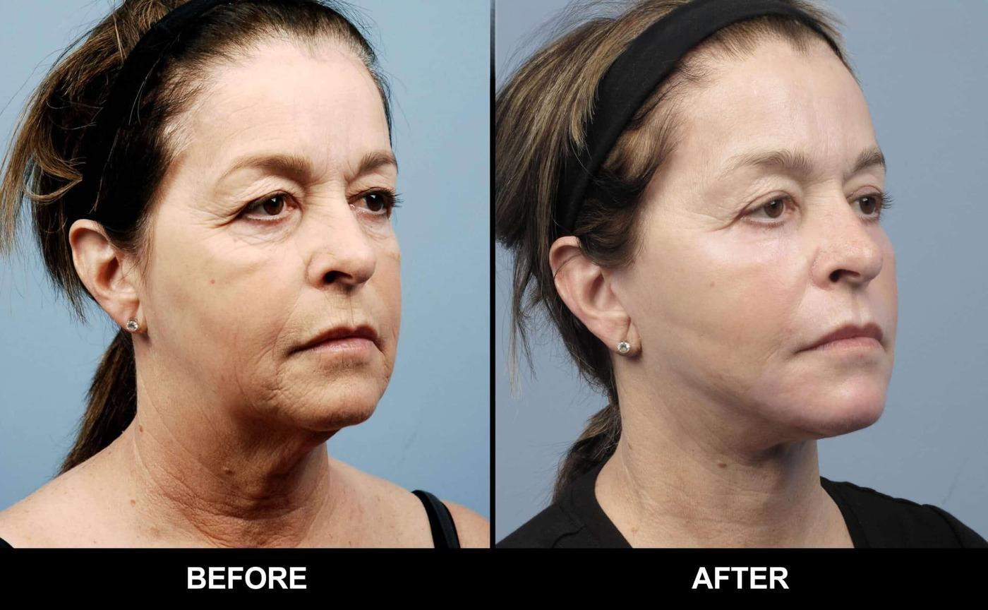 Fractional Erbium Laser - Before and After Gallery – Photo 43