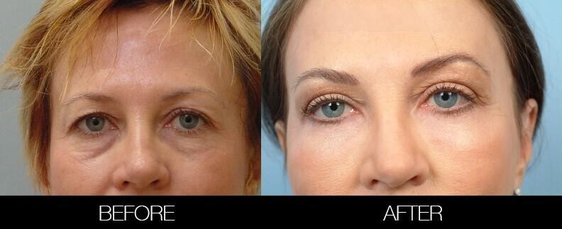 Fractional Erbium Laser - Before and After Gallery – Photo 46