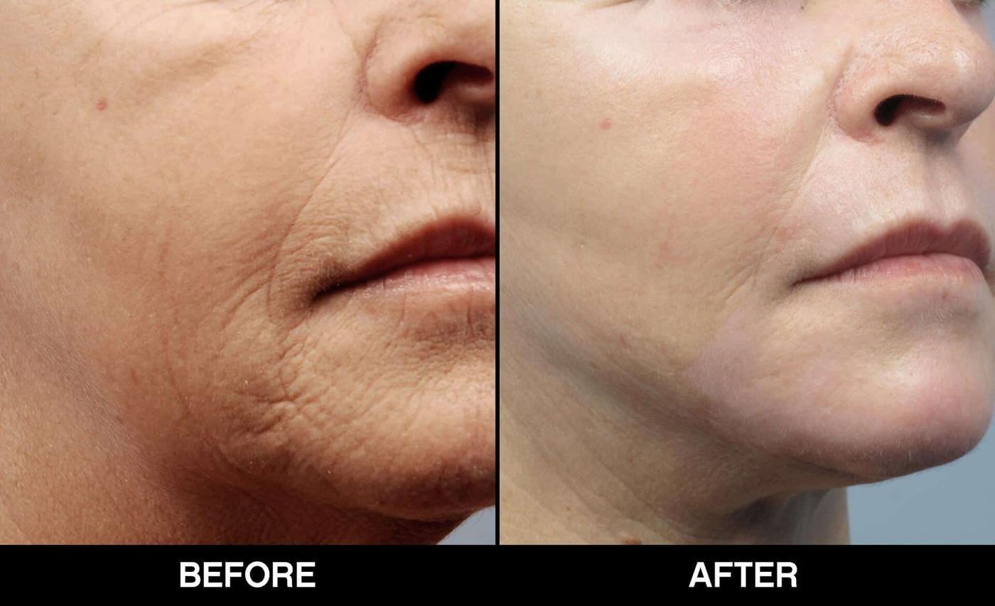 Fractional Erbium Laser - Before and After Gallery – Photo 37